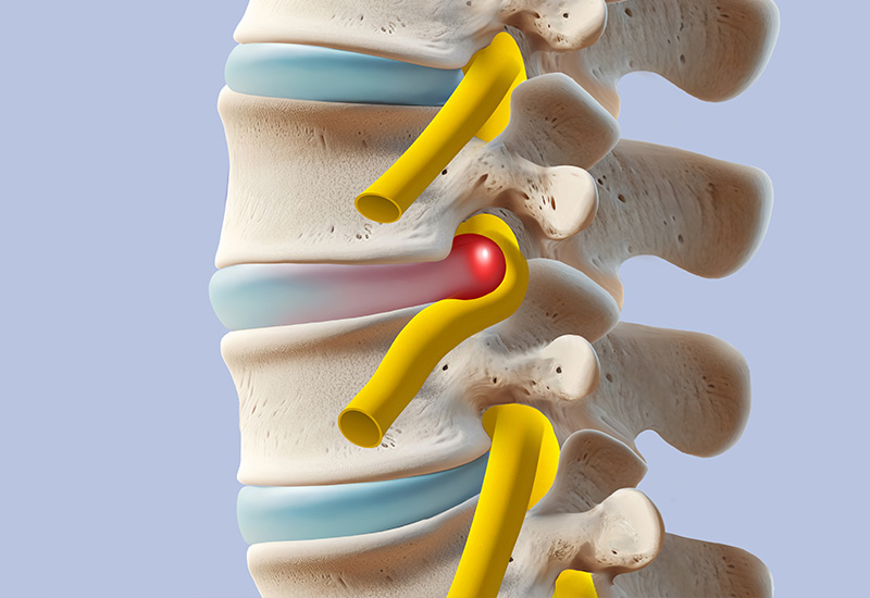 디스크 통증·퇴행성 변화
